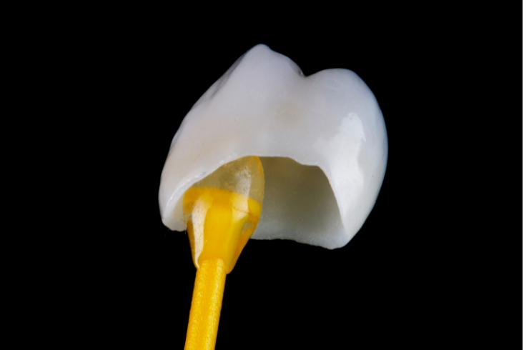 Dental Crowns & Bridges